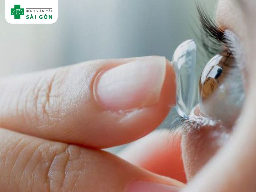 Sử dụng kính áp tròng không đảm bảo chất lượng