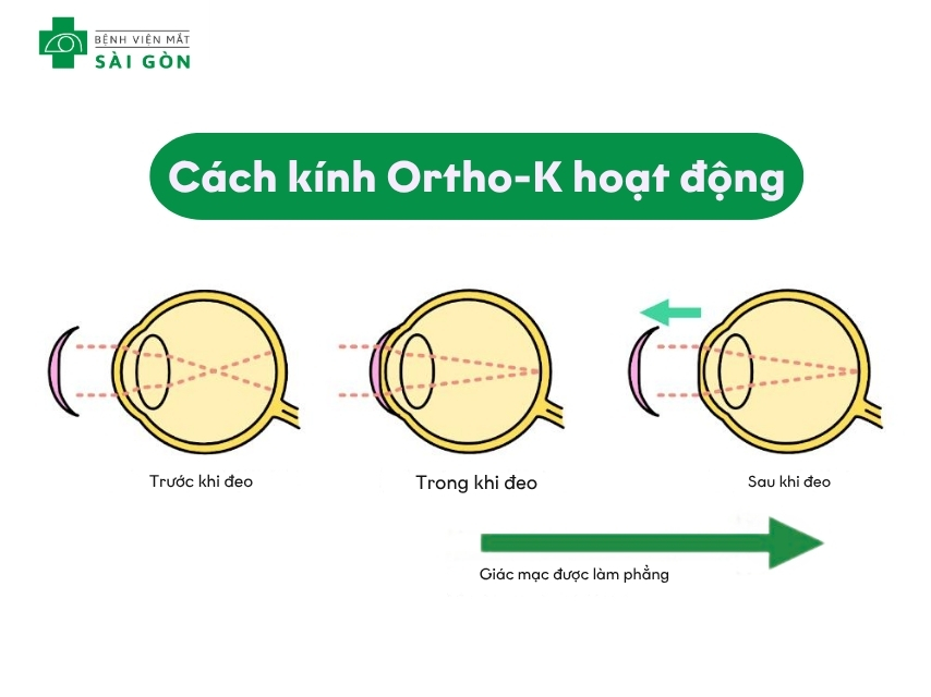 Kính áp tròng Ortho-K làm phẳng giác mạc