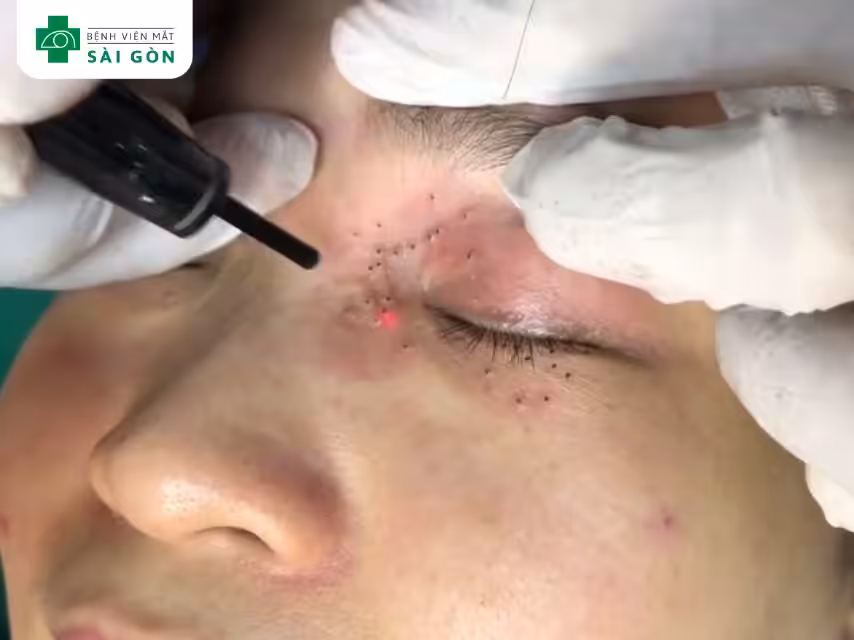 Phương pháp đốt điện hoặc laser