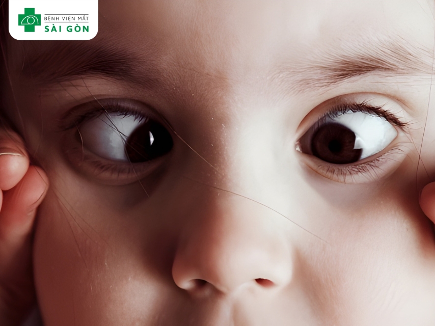  Lé kim ở trẻ chủ yếu do bẩm sinh, thường xuất hiện ngay khi sinh