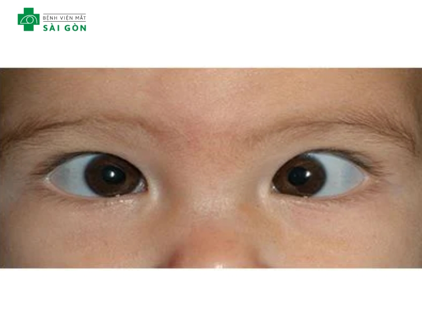 Lé kim là tình trạng hai mắt lệch hướng