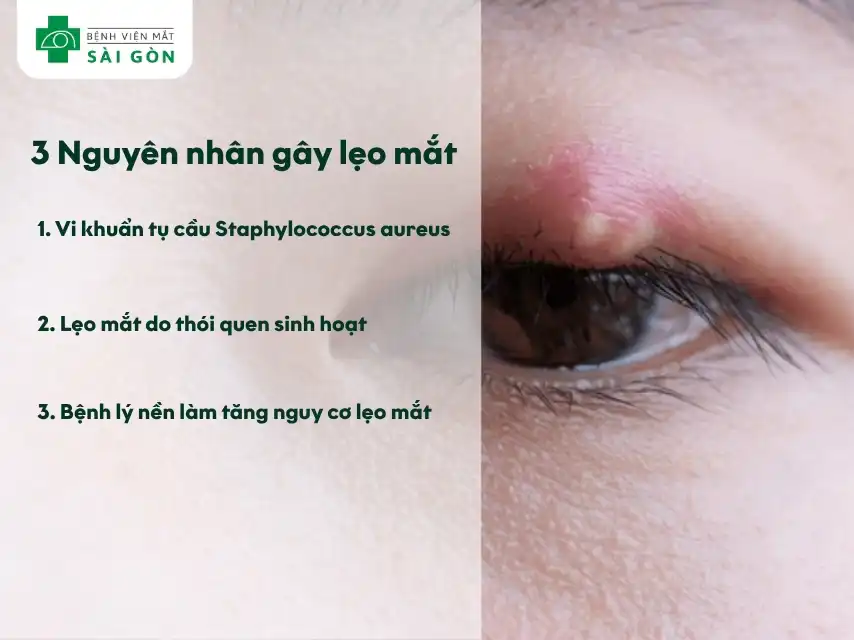 Nguyên nhân gây lẹo mắt