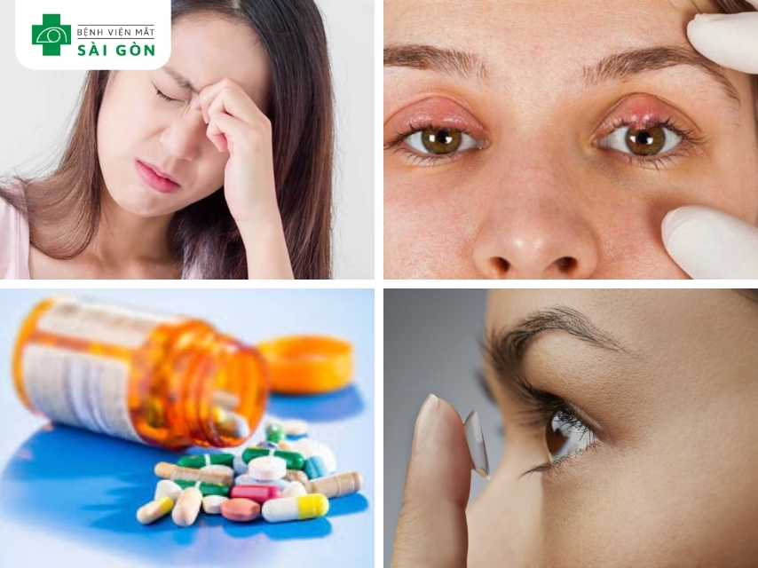 Hỗ trợ điều trị lẹo mắt với các hành động không nên làm