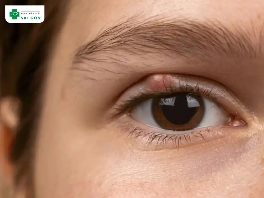 Lẹo mắt do vi khuẩn gây ra