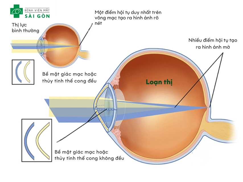 Loạn thị là một tật khúc xạ của mắt