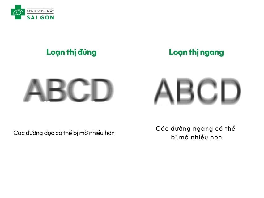 Loạn thị dạng đứng phổ biến