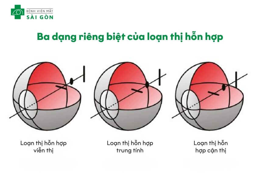 Ba dạng riêng biệt của loạn thị hỗn hợp