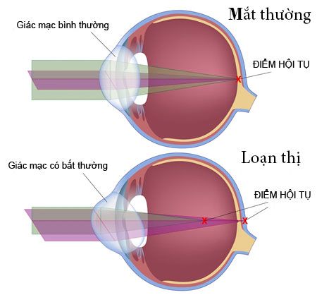 loạn thị