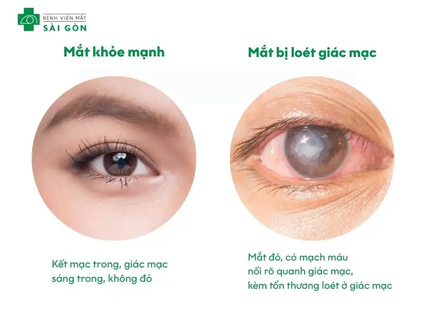 Loét giác mạc là gì