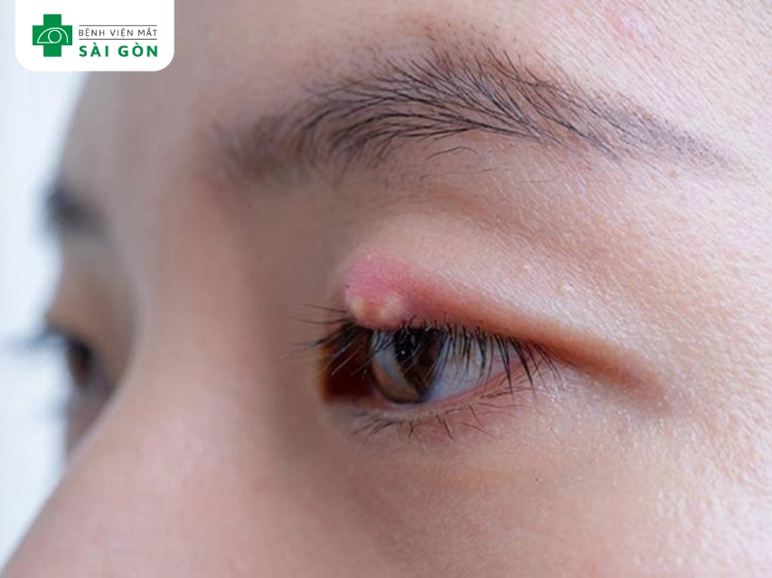 Không tự ý chọc lẹo mắt để tránh nhiễm khuẩn