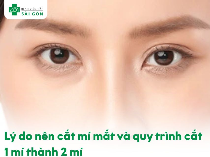 Lý do nên cắt mí mắt 