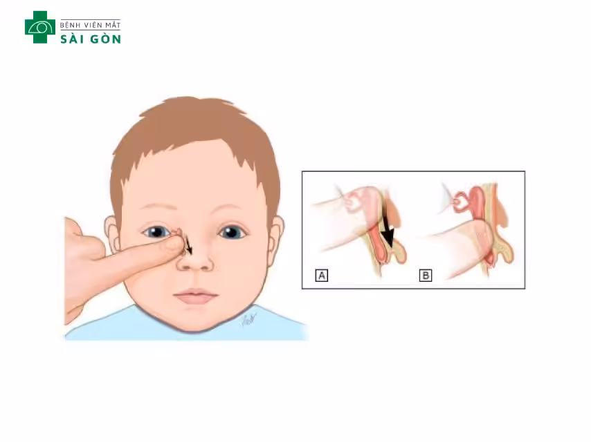 Massage tuyến lệ cho trẻ