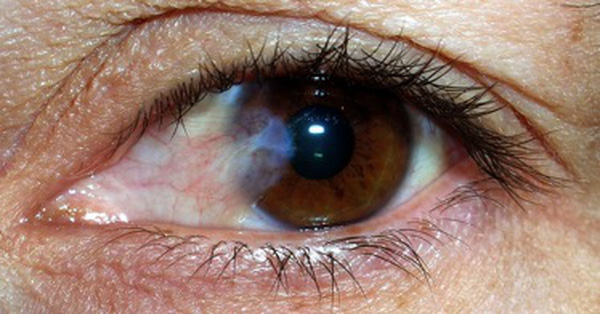 Mộng mắt : những điều cần biết và hướng điều trị