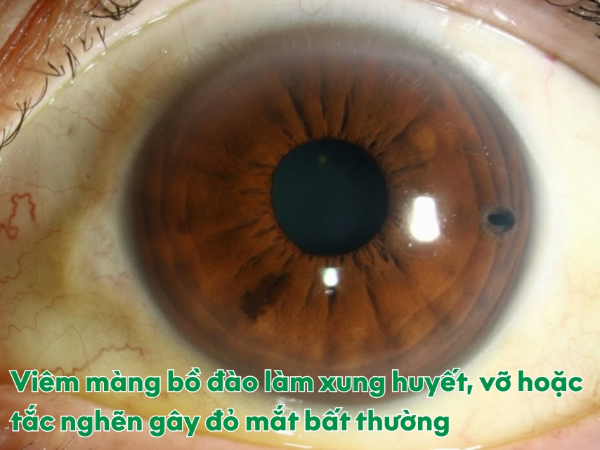 Glôcôm làm mất thị lực vĩnh viễn