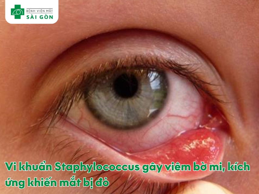 Mắt bị đỏ do viêm bờ mi