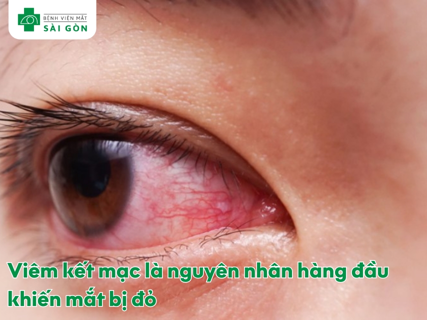 Đau mắt đỏ là viêm bề mặt mắt do nhiễm trùng hoặc kích ứng