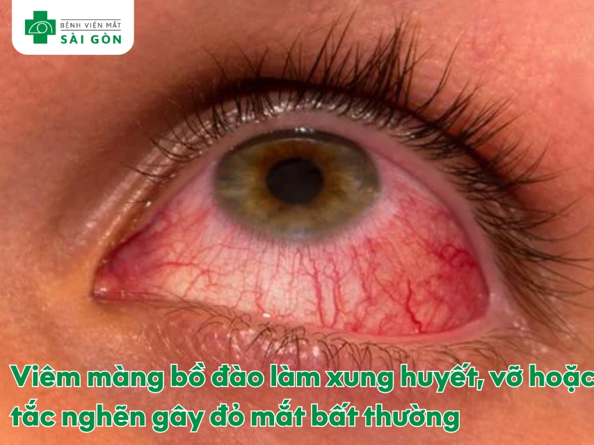 Viêm màng bồ đào làm cho mắt đỏ, đau nhức, sợ ánh sáng