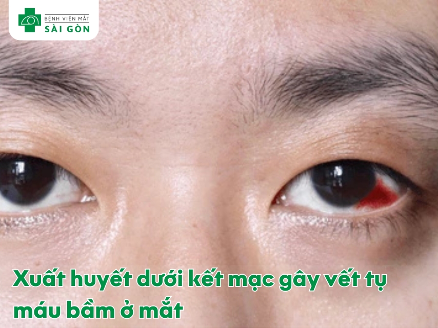Mạch máu nhỏ trong lòng trắng vỡ gây xuất huyết dưới kết mạc