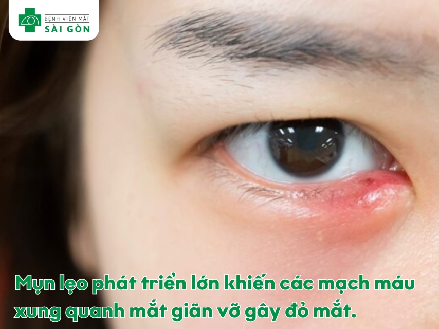 Khối u nhỏ xuất hiện bên trong mí mắt là mụn lẹo