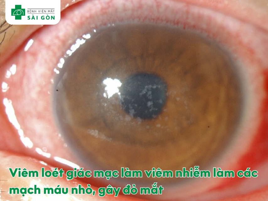 Mắt bị đỏ do viêm loét giác mạc