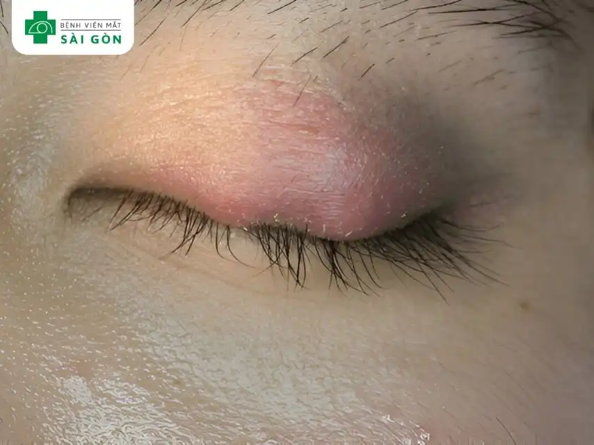 Thời gian hồi phục sưng mí mắt