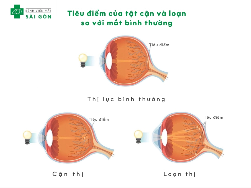 Mắt cận loạn là tình trạng bị cận thị, loạn thị