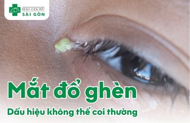 Tìm hiểu chung về tình trạng mắt đổ ghèn