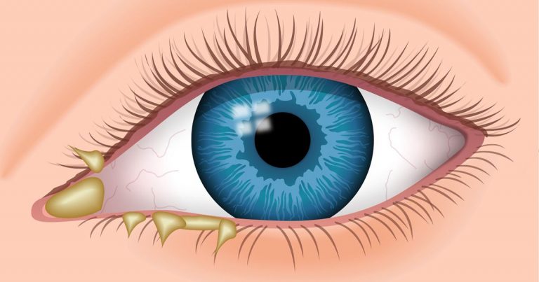 Mắt đổ ghèn dấu hiệu không thể coi thường mắt đổ ghèn