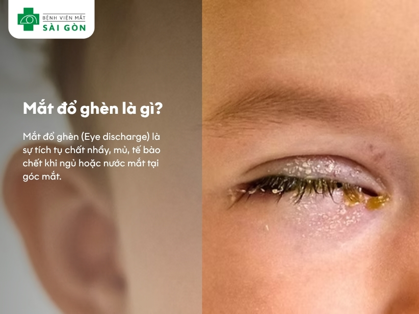 Mắt đổ ghèn là tình trạng gì