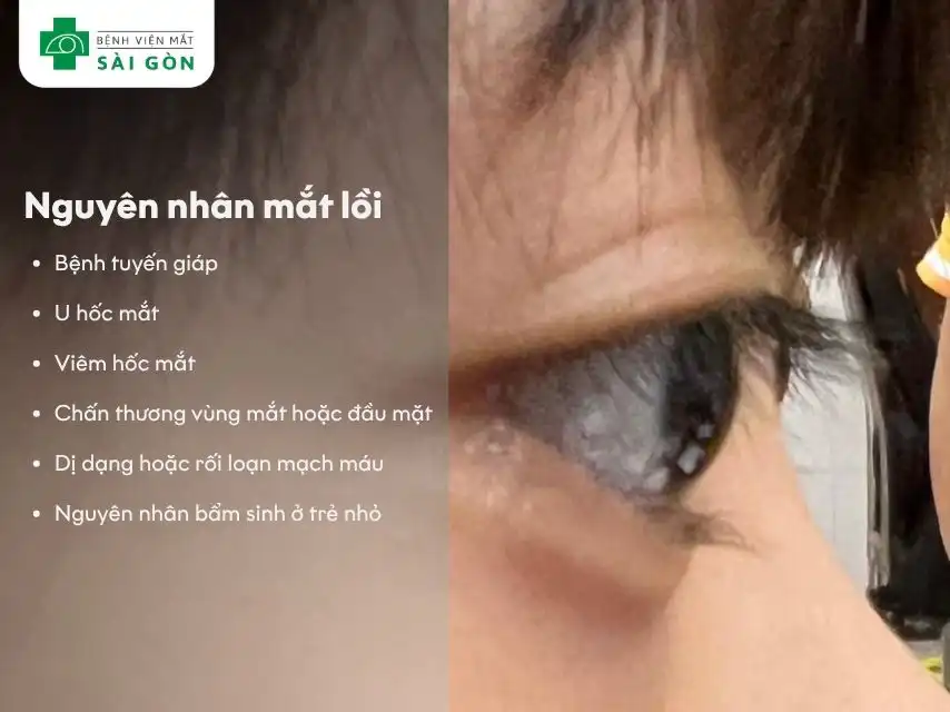 Bệnh lý tuyến giáp tự miễn gây cường giáp và có biến chứng ở mắt.