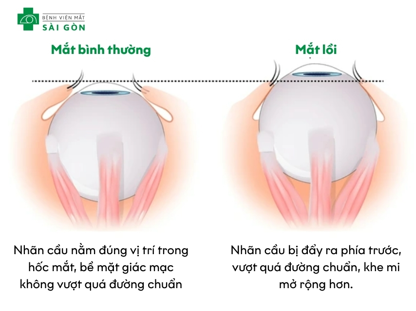 Nhãn cầu của mắt bị đẩy ra phía trước