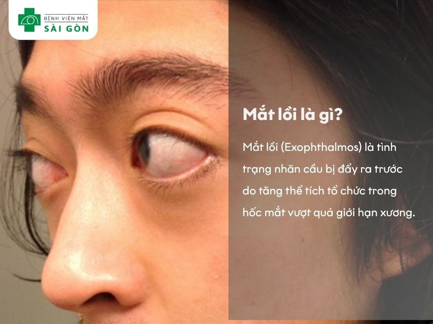 Mắt lồi là hiện tượng nhãn cầu nhô ra phía trước khỏi hốc mắt