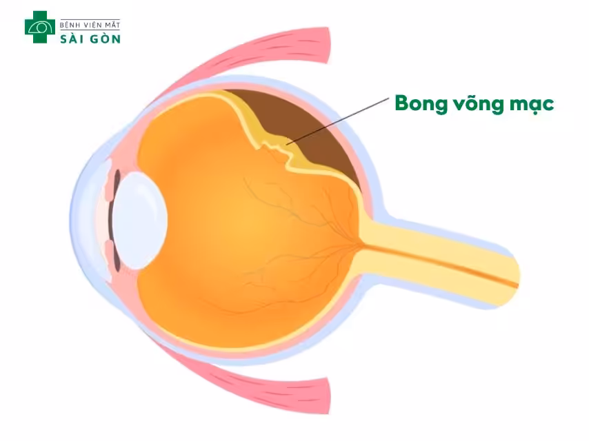 Mắt mờ do bong võng mạc