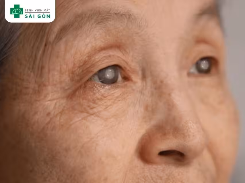 Đục thủy tinh thể