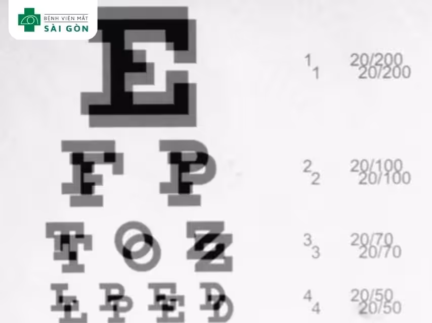 Mắt mờ là bị gì?