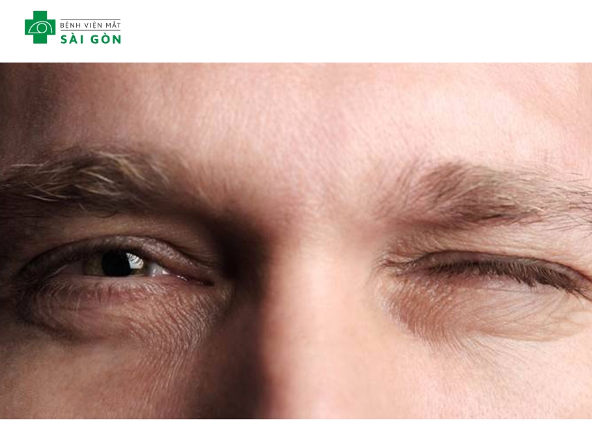 Mắt trái giật là hiện cơ mí co thắt không phải tâm linh