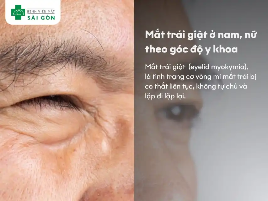 mắt trái giật theo định nghĩa y khoa