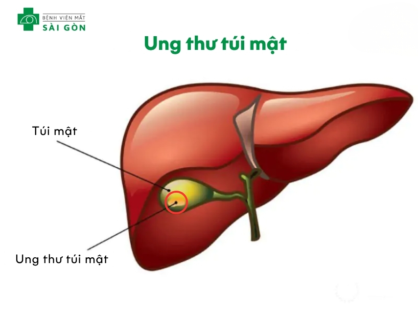 Mắt vàng cảnh báo về ung thư túi mật
