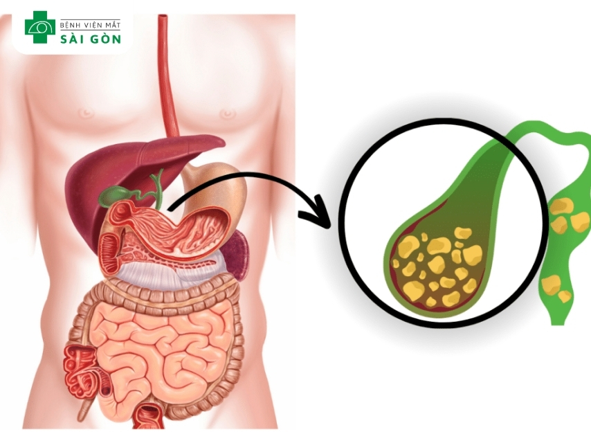 Mắt vàng là dấu hiệu cảnh báo bệnh lý về sỏi mật