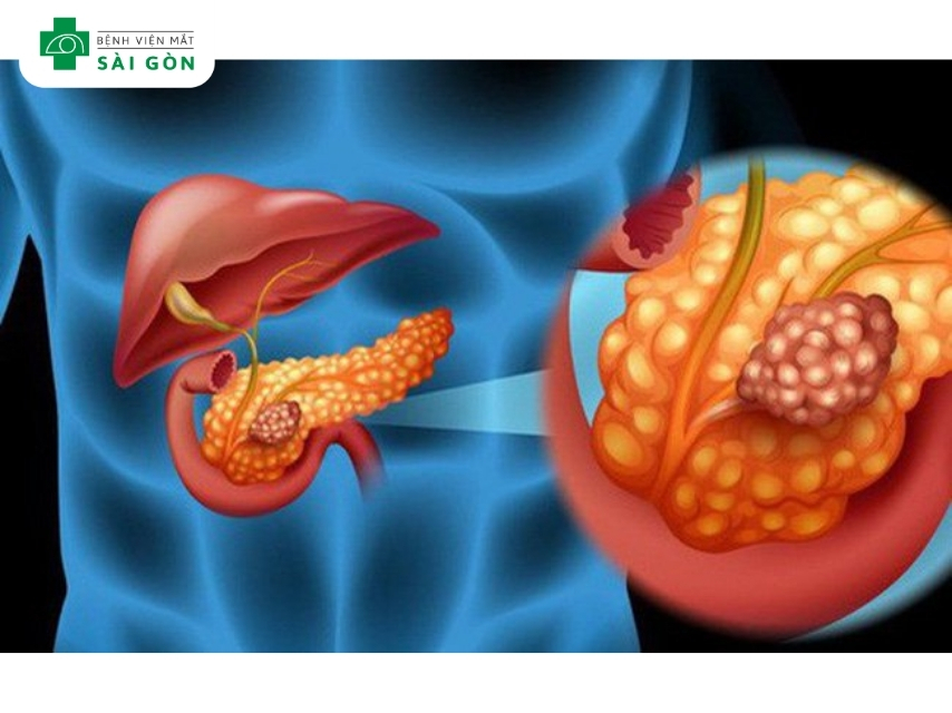 Mắt vàng dấu hiệu cảnh báo ung thư tụy