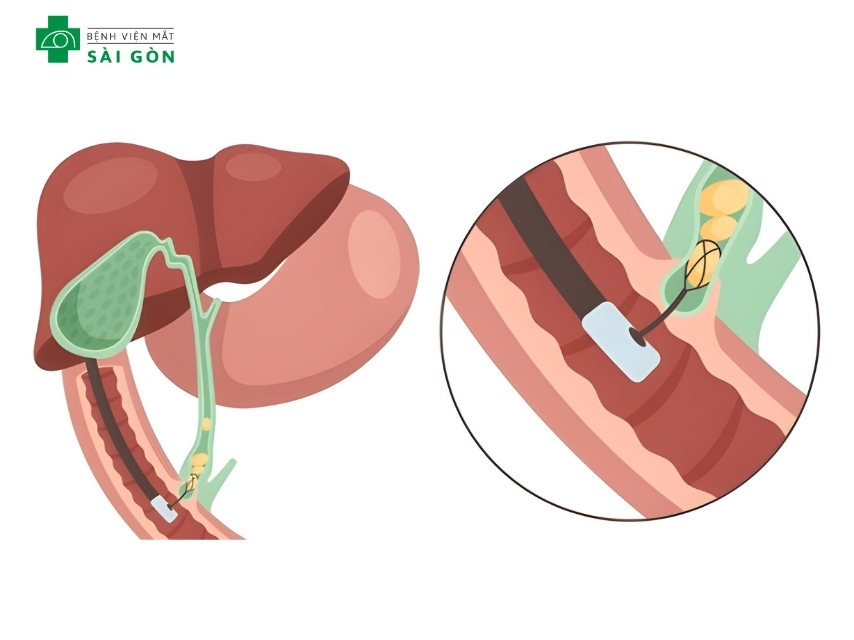 Mắt vàng cảnh báo bệnh ống mật chủ
