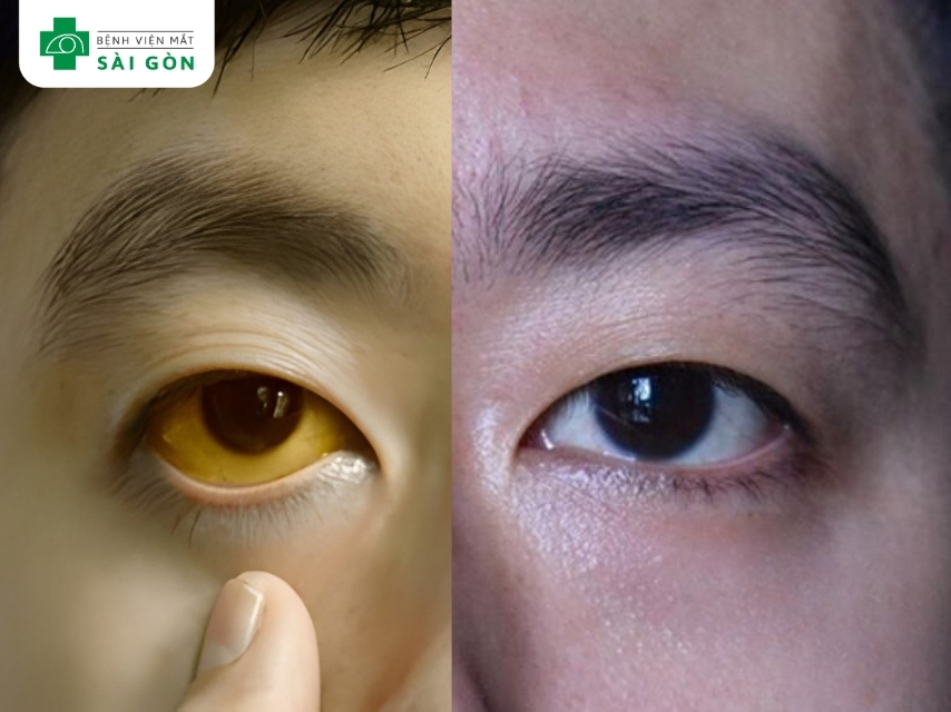 Mắt chuyển sang vàng do tích tụ bilirubin trong máu