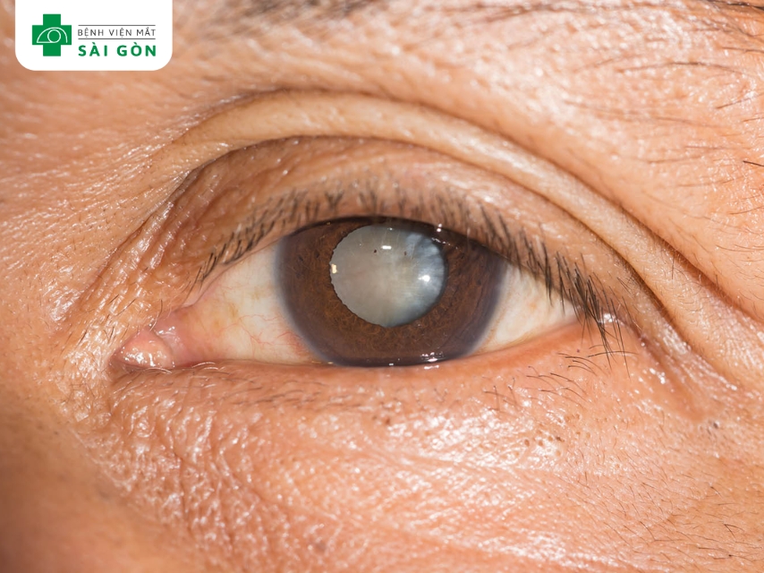Đục thủy tinh thể gây mỏi mắt