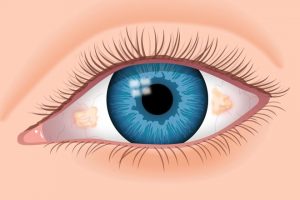 Bệnh mộng mỡ mắt và cách điều trị mộng mỡ mắt