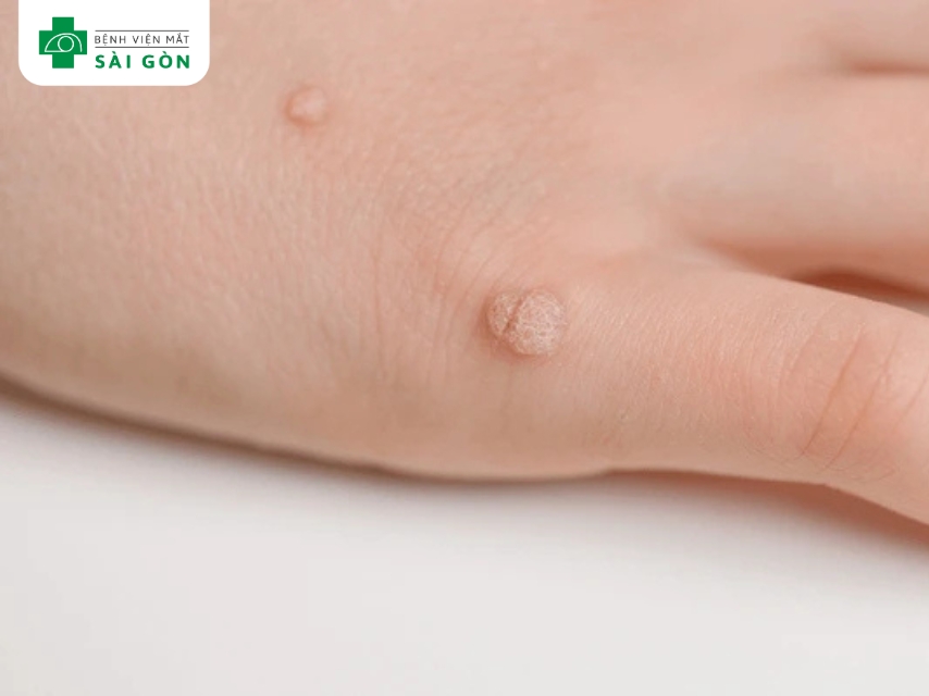 Mụn cóc là mụn cơm do virus HPV gây ra