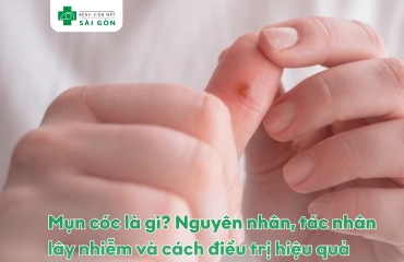 mụn cóc
