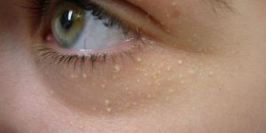 Mụn cơm, dấu hiệu nhận biết và cách điều trị mụn cơm