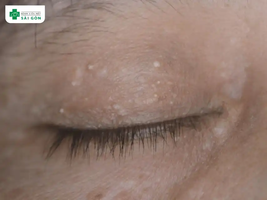 Mụn cơm do virus papiloma gây ra