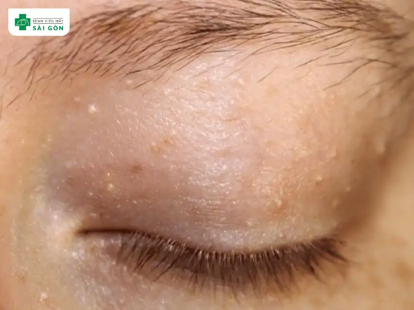 Mụn mắt xuất hiện dạng nốt nhỏ màu trắng