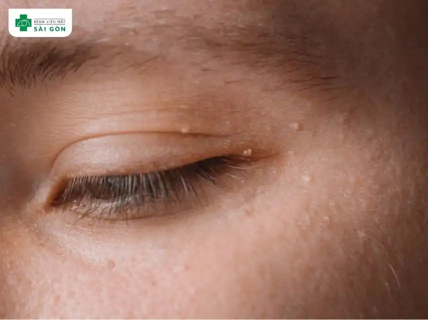 Mụn mắt xuất hiện trên hoặc mí
